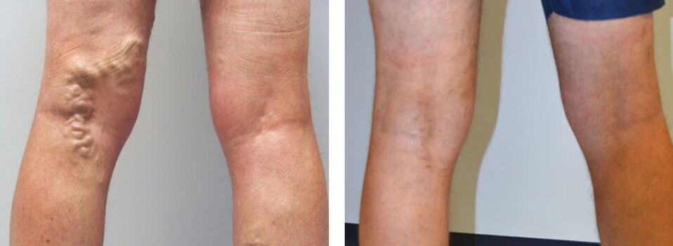 Foto vor und nach der Verwendung von Veniselle, die Erfahrung der Verwendung von Creme