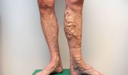 Krampfadern bei Männern