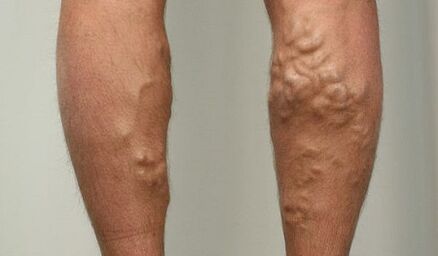 Symptome von Krampfadern