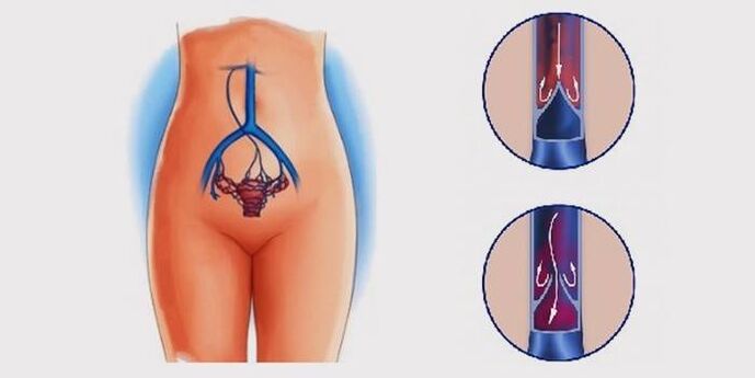 Krampfadern des Beckens.