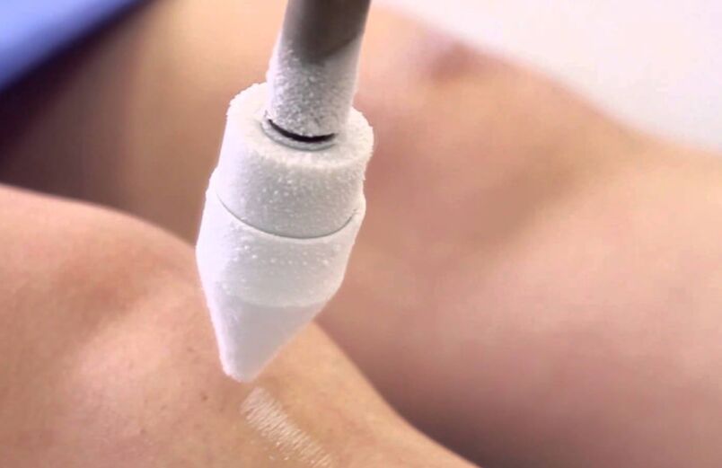 Behandlung von Krampfadern in den Beinen mit Kryotherapie