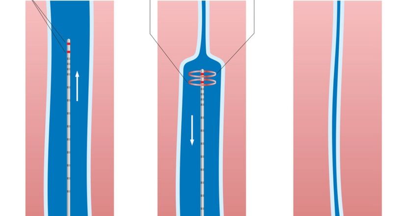 Laserbehandlung von Krampfadern an den Beinen.