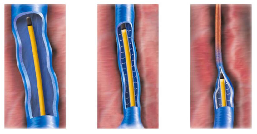 Radiofrequenzablation als Methode zur Behandlung von Krampfadern.
